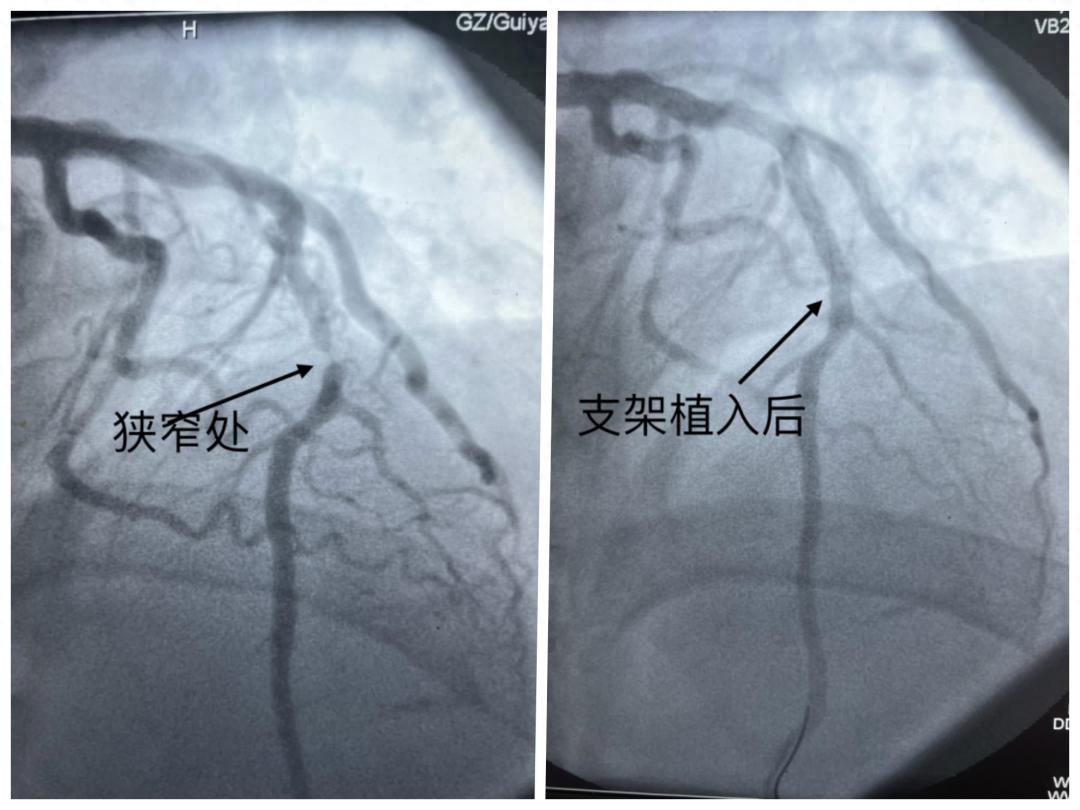 别不当回事!男子牙疼数日,没想到是心肌梗死……