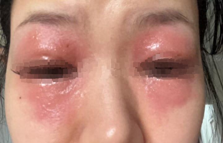 女子种睫毛后双眼红肿自称一个月前得过荨麻疹医生：过敏体质